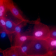 Breast cancer cells. Image: National Cancer Institute